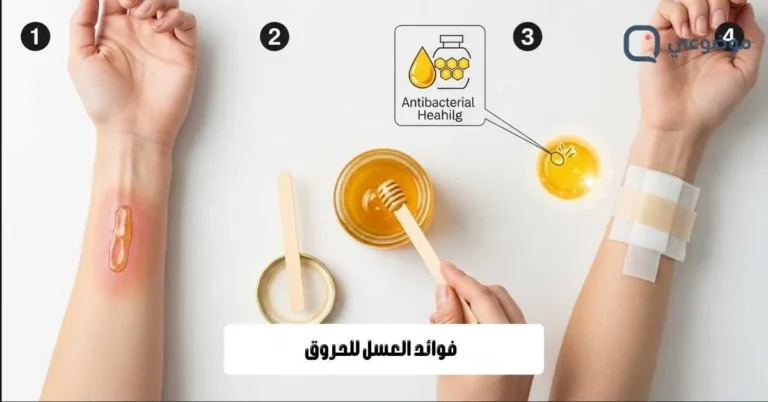 فوائد العسل للحروق